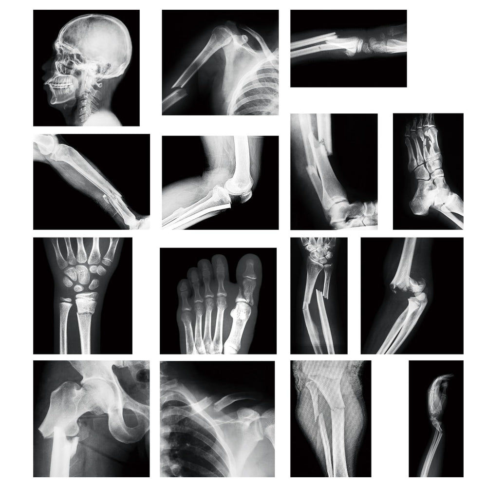 Sayglossy broken bones X-ray panels for hands-on learning