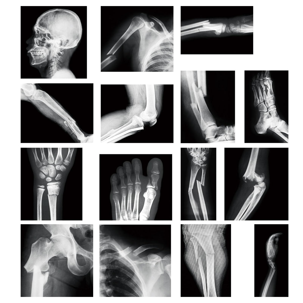 Sayglossy broken bones X-ray panels for hands-on learning